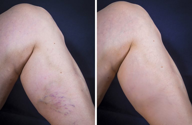 Adult woman leg with varicose veins before and after treatment on dark background